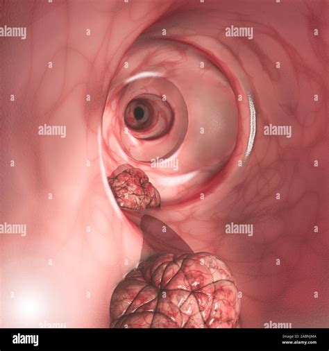 Vista interna de las paredes intestinales El cáncer colorrectal CCR