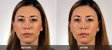 Dermal Fillers — Rejuvenate Wellness & MedSpa