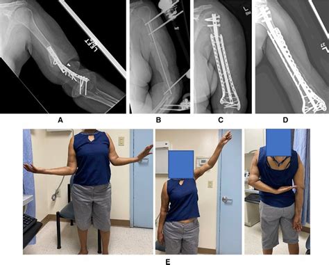 A Ap View Of The Left Humerus Demonstrates A Left Distal Humeral Shaft Download Scientific