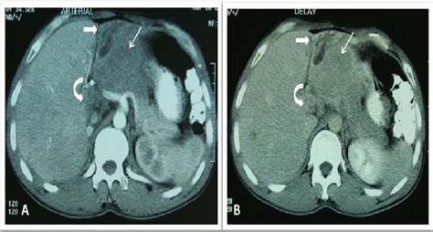 Abdominal CT Scan With IV And Oral Contrast A Arterial Phase B