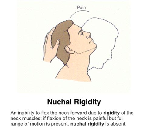 Nuchal Rigidity