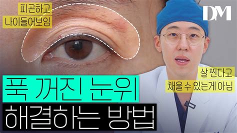 가난해 보이는 눈의 상징 꺼진눈 눈 두덩이가 꺼지는 이유와 해결방법 지방이식 눈패임 눈꺼짐 안검하수 Youtube