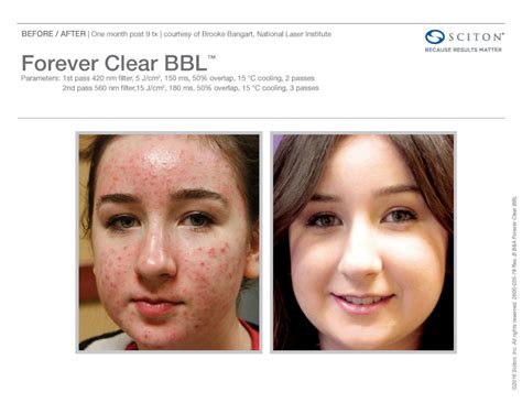 Sciton Bbl Laser Treatments Alabama Medical Group