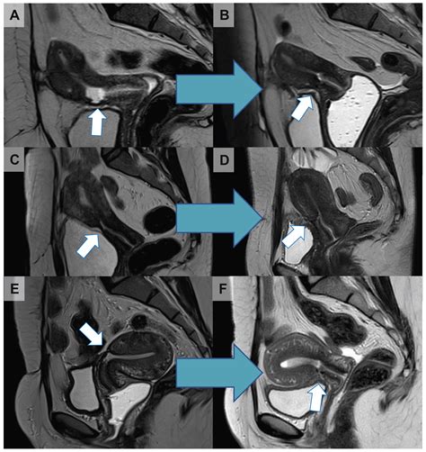 Cesarean Scar Defects Management Of An Iatrogenic Pathology Whose Prevalence Has Dramatically