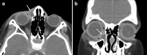 Dacryocystitis In An 8 Year Old Girl A B Axial A And Coronal B