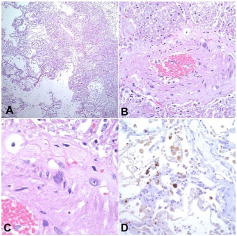 Photomicrographs Of The Lungs Exhibiting Necrotizing Bronchopneumonia Download Scientific