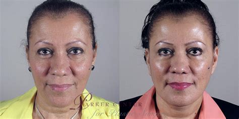 Facelift Before And After Pictures Case 19 Paramus New Jersey Parker Center For Plastic Surgery