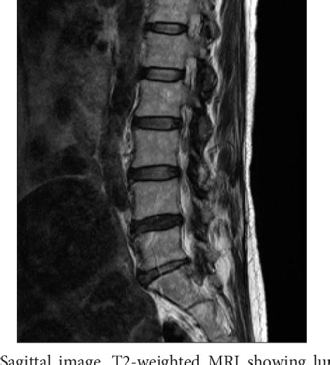 Figure 1 from Middle cluneal nerve entrapment neuropathy attributable ...