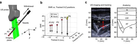 Three Dimensional Ultrasonic Needle Tip Tracking With A Fiber Optic