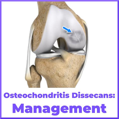 Knee Osteochondritis Dissecans Treatment - Sports Medicine Review