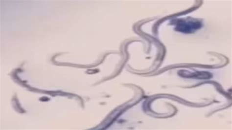 Watch Microscopic View Of Finger Nails Shows Germs Bacteria Crawling