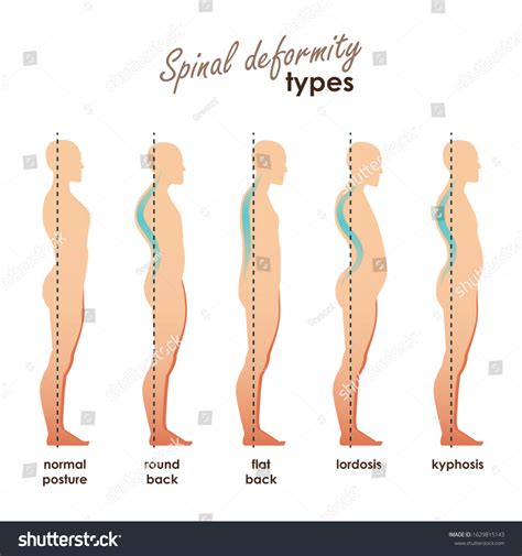 Spinal Deformity Types Diseases Of The Spine Royalty Free Stock