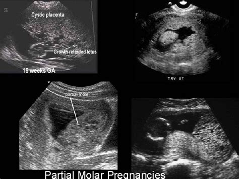 Gestational Trophoblastic Disease GTD Part I Molar Pregnancy