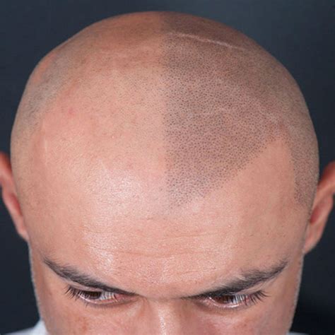 Scalp Micropigmentation For Men Hairvision Clinic Prahran