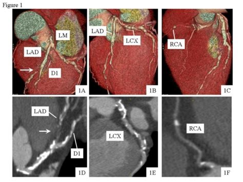 Mdct Volume Rendering Upper Panels A B C And Multiplanar