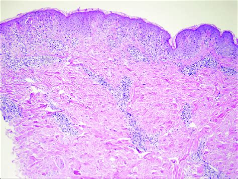 Perivascular And Interstitial Infiltration Composed Of Neutrophils Download Scientific Diagram