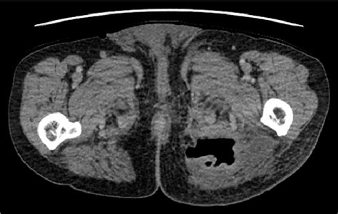 Enhanced Ct Showed An Abscess In Left Gluteus Maximus Muscle Figure 4