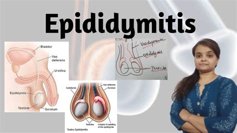 Epididymitis Youtube