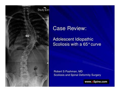 Case Review 5 14 Year Old Female With Adolescent Idiopathic Scoliosis