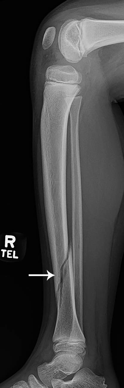 Distal Tibia Fibula Fracture