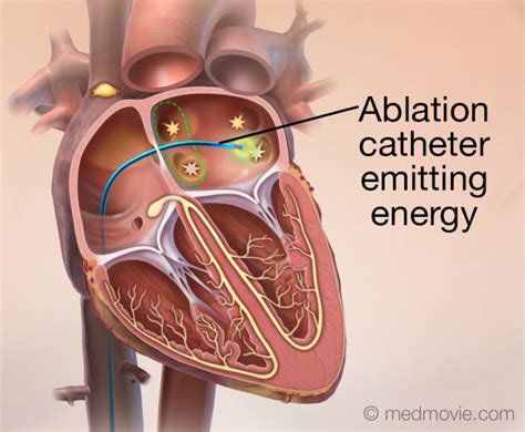 Catheter Ablation