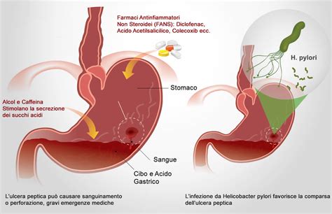 Ulcera Peptica Cause e Sintomi È Grave Dieta e Cure