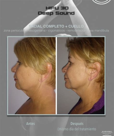 LIFTING SIN CIRUGIA HIFU FACIAL COMPLETO Ubicaciondepersonas Cdmx Gob Mx