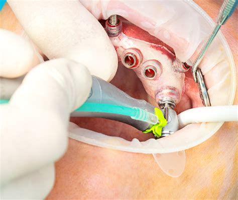 Dental Implants With Guided Tooth Implant Placement