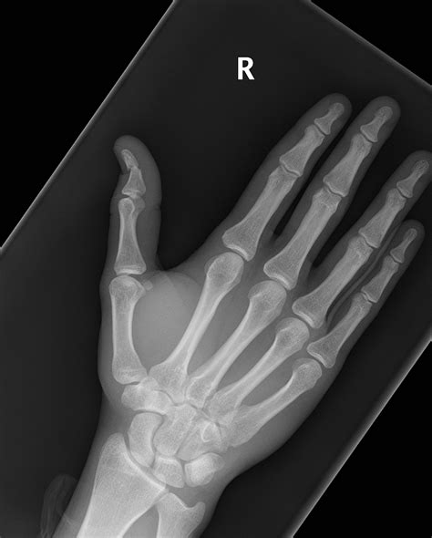 Thumb Distal Phalanx Fracture Image Radiopaedia Org