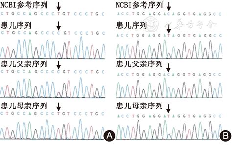 Lamc3基因复合杂合突变的婴儿痉挛症一例