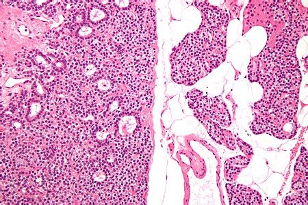 Parathyroid adenoma - Libre Pathology