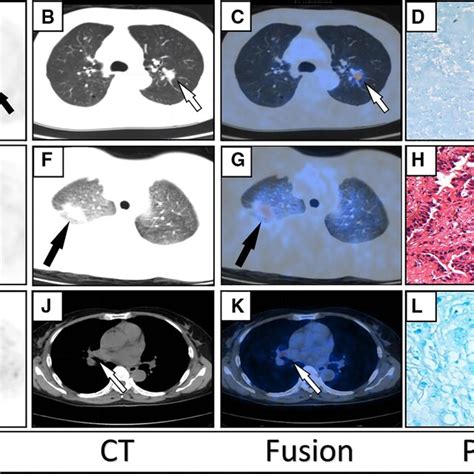 AD Axial PET CT Fused PET CT Images And Pathology Of A