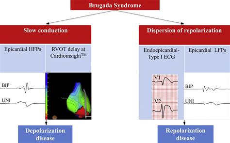 High Density Epicardial Mapping In Brugada Syndrome Depolarization And