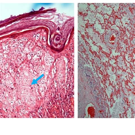 A Skin With Focal Marked Cytoplasmic Swelling And Ballooning