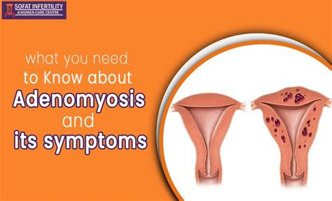 Adenomyosis Causes Symptoms Diagnosis And Treatment