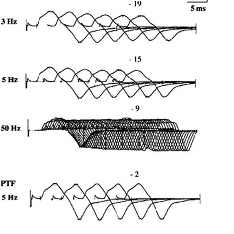Pdf Distinguishing Features Of The Repetitive Nerve Stimulation Test