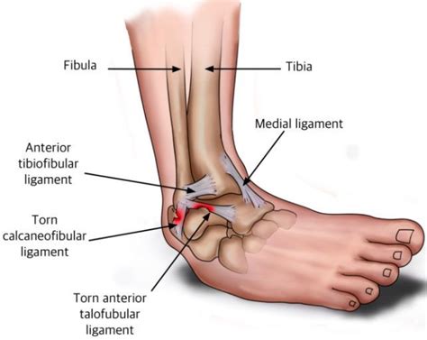 Fmpa How To Rehab An Atfl Ankle Injury In Football With Empowerband