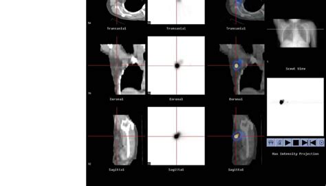 CT, gamma camera, and SPECT/CT fusion images in transaxial, coronal ...