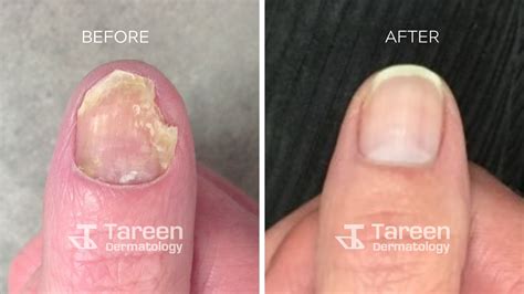 Skin, Hair & Nail Fungal Infection Treatment | Tareen Dermatology - Tareen Dermatology