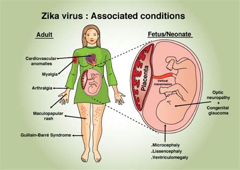 Virus del Zika síntomas causas y tratamiento Medicina Básica