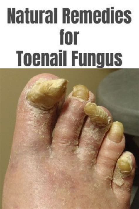 Diy Easy To Make Nail Polish That Kills Fungus Nail Fungus Artofit