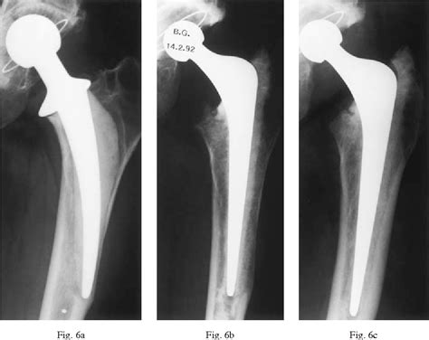 Pdf Femoral Impaction Grafting With Cement In Revision Total Hip