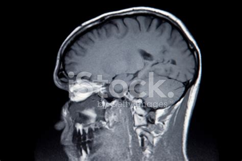 Mri Brain Scan Stock Photo | Royalty-Free | FreeImages