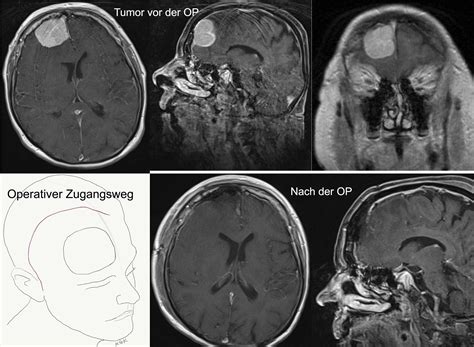 Hirntumor Dernerv