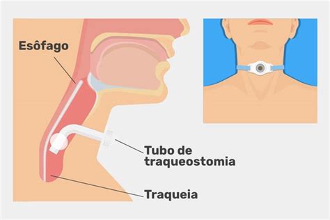 Traqueostomia O Que Para Que Serve E Cuidados Tua Sa De