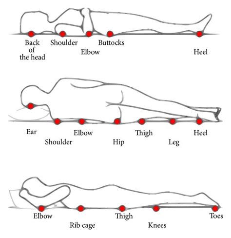 Pressure Ulcer Diagram