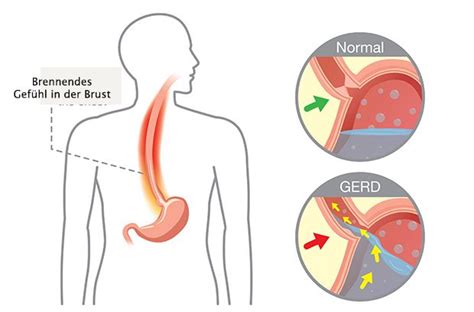 Reflux Sophagitis Verlauf Symptome Behandlung Und Pr Vention