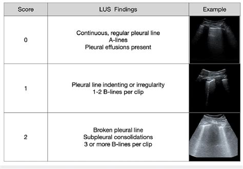 Modified Soldati Scoring System Used To Assess Lung Ultrasound Lus