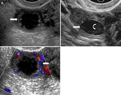 Transvaginal Ultrasound Ovarian Cysts