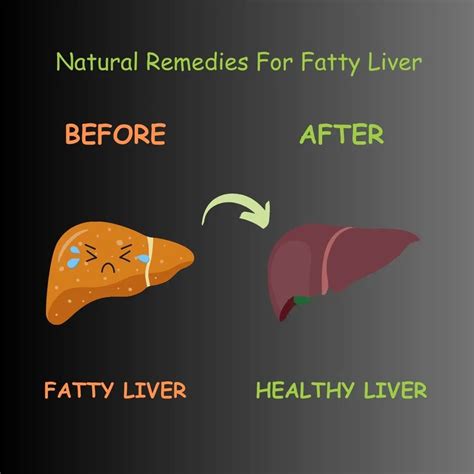 5 Natural Remedies For Fatty Liver What Is Fatty Liver Vitavida